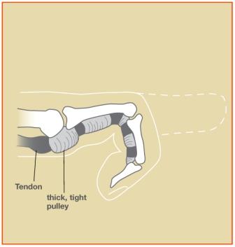 Abnormal anatomy of finger