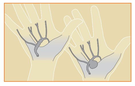 Aneurysms of the hand