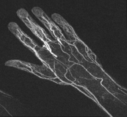 Angiography (MRA) of the hand