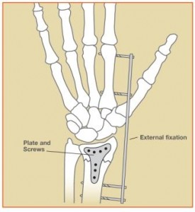 WristFracture2_c